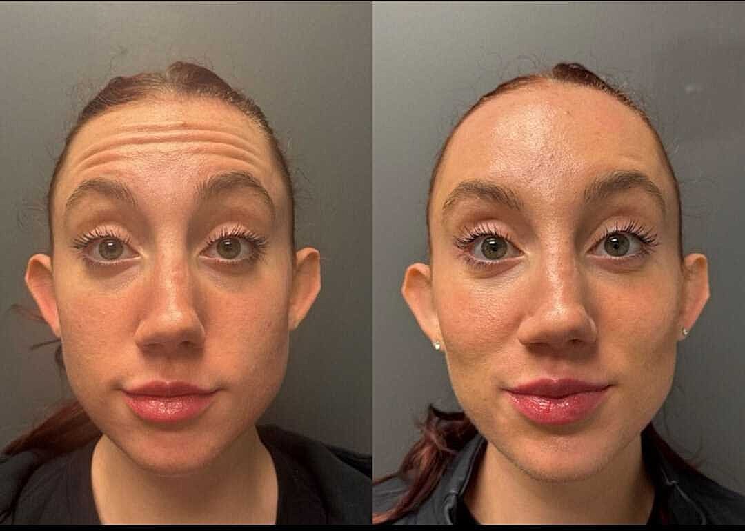Botox Before & After