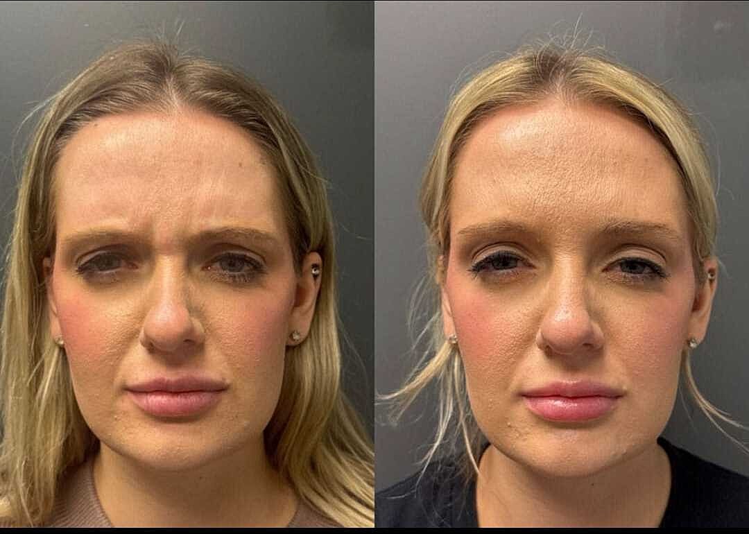 Botox Before & After