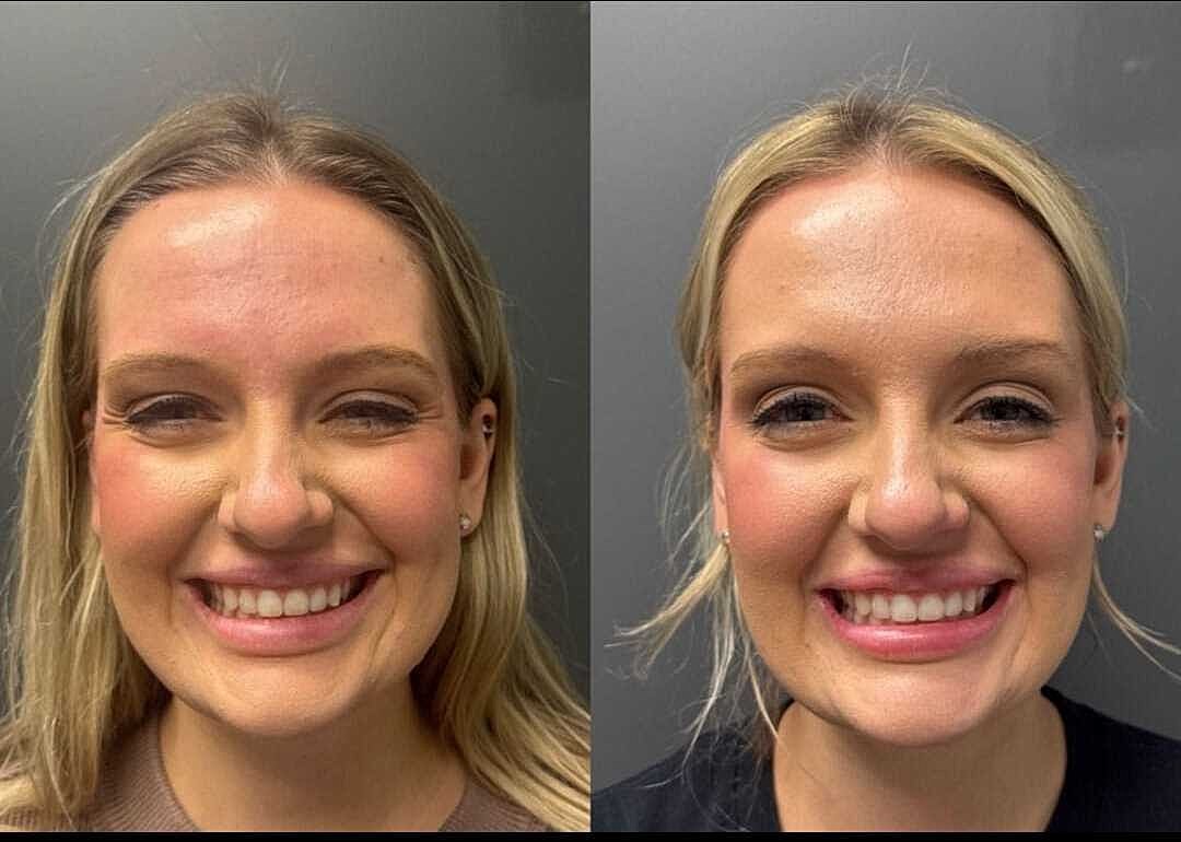 Botox Before & After