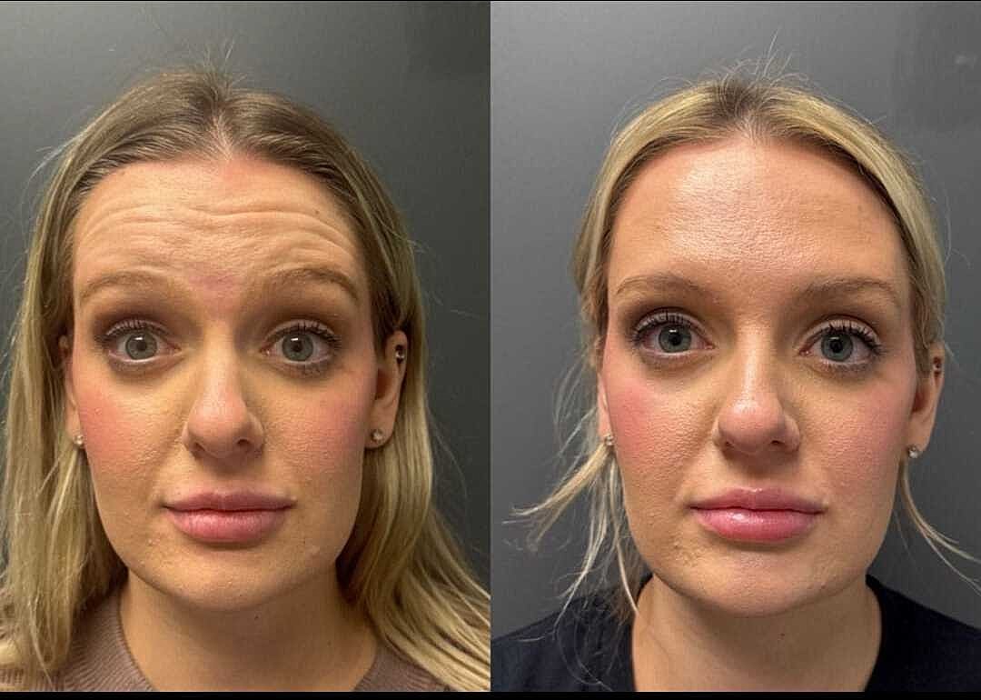 Botox Before & After