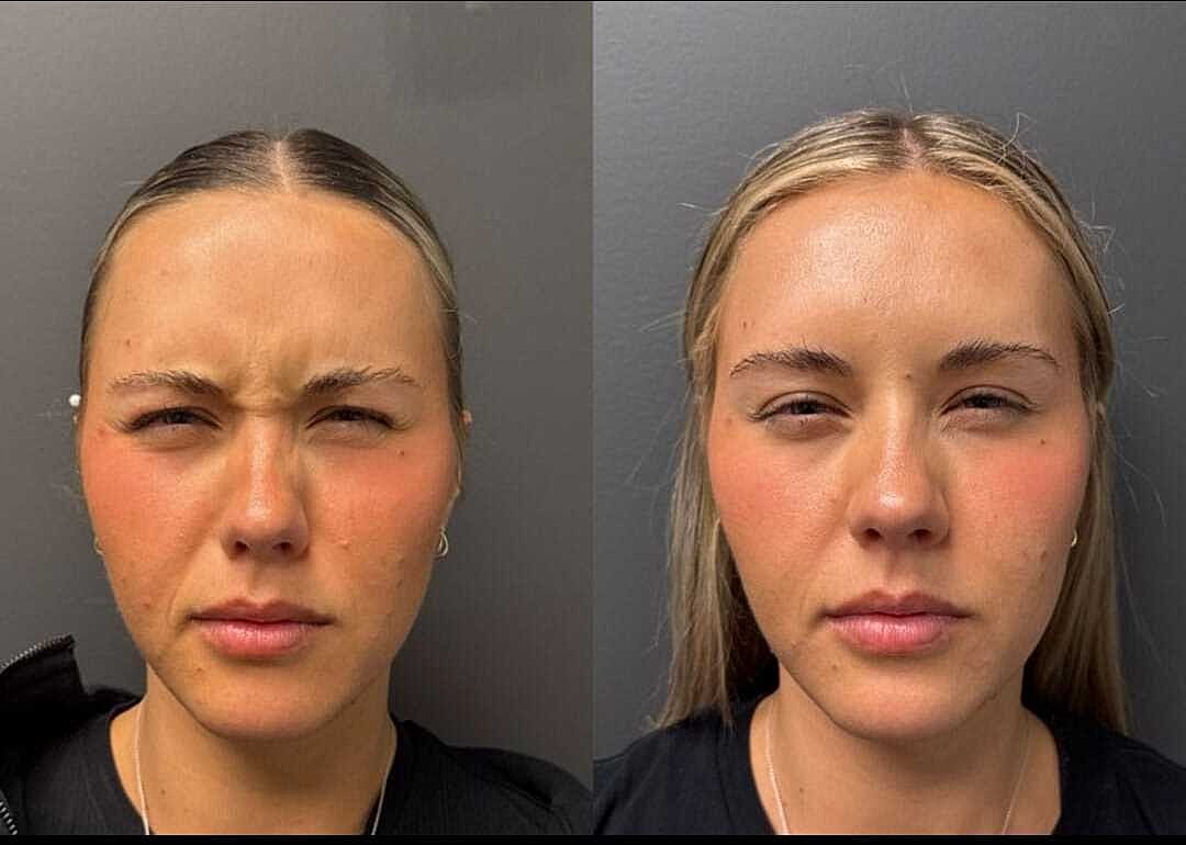 Botox Before & After