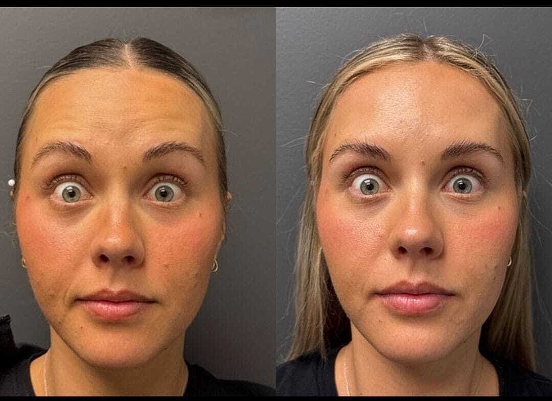 Botox Before & After