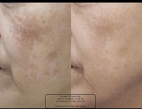Melasma Before & After