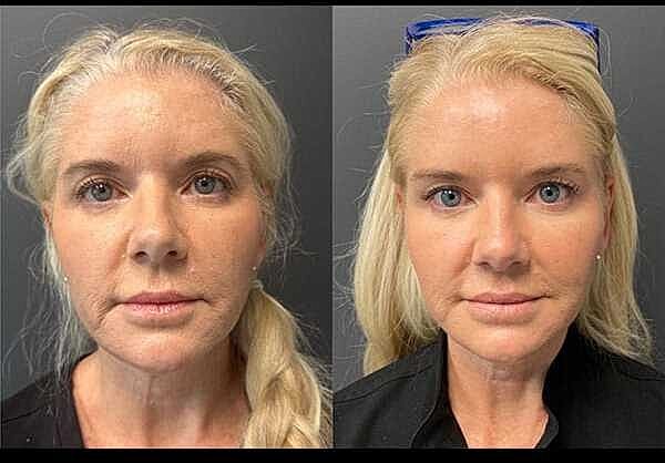 Skinvive Before & After