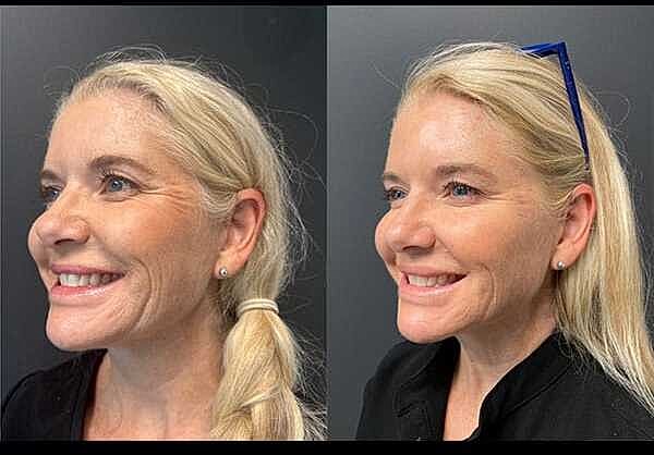 Skinvive Before & After
