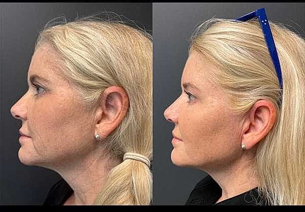 Skinvive Before & After