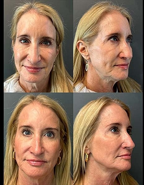 Skinvive Before & After