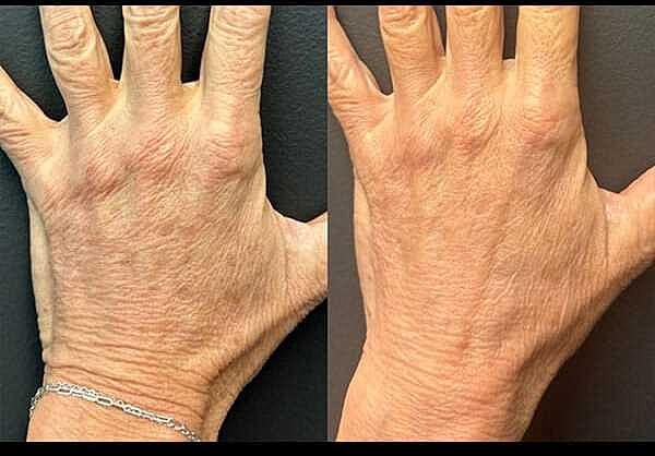 Microneedling Before & After