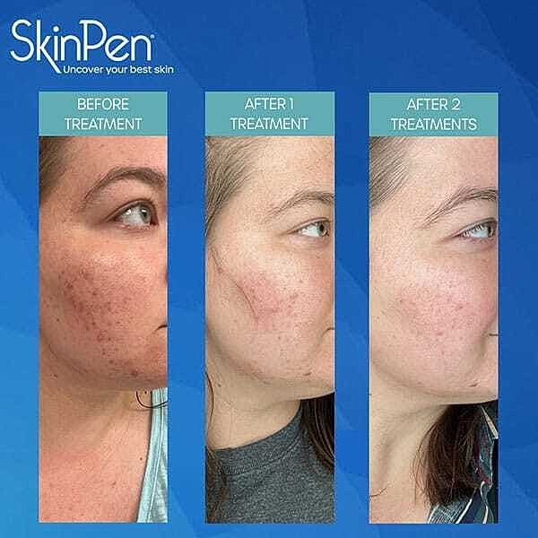 Microneedling Before & After