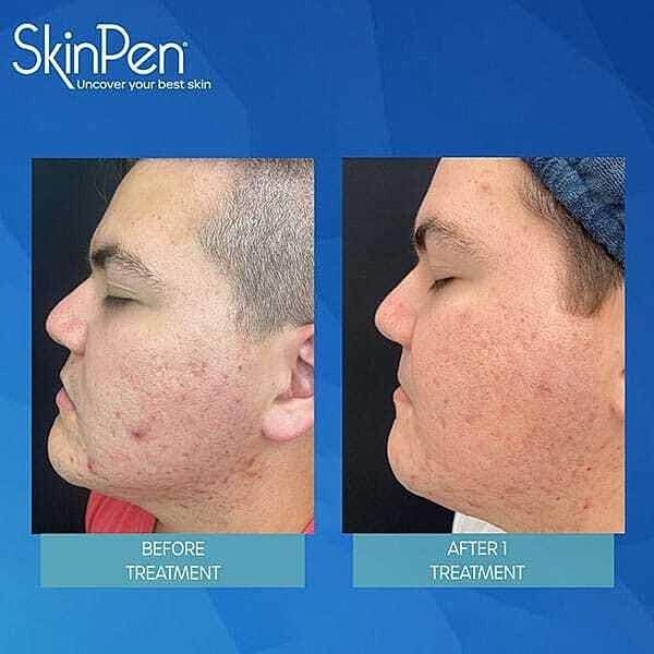Microneedling Before & After