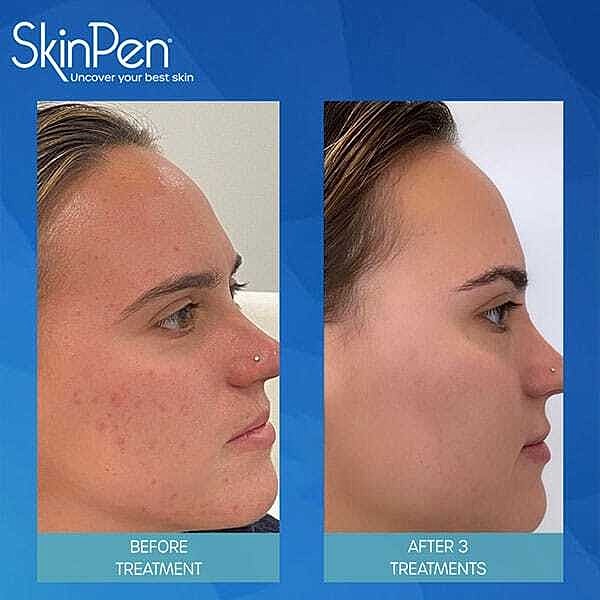 Microneedling Before & After