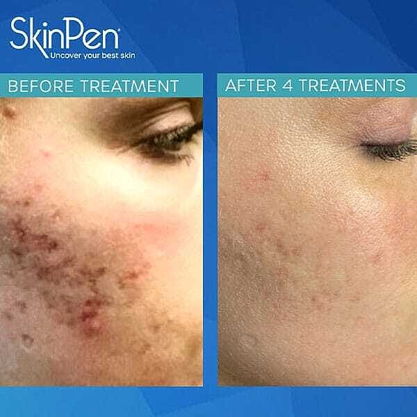 Microneedling Before & After