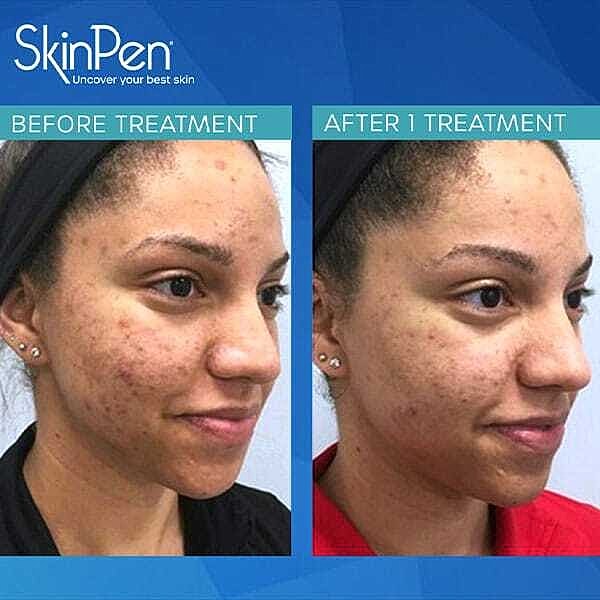 Microneedling Before & After