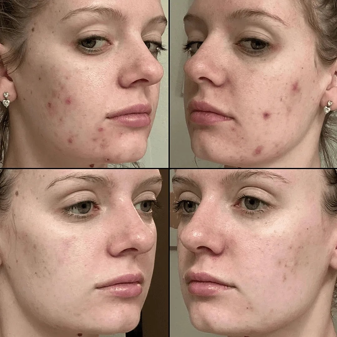 before and after results from acne treatment in scottsdale