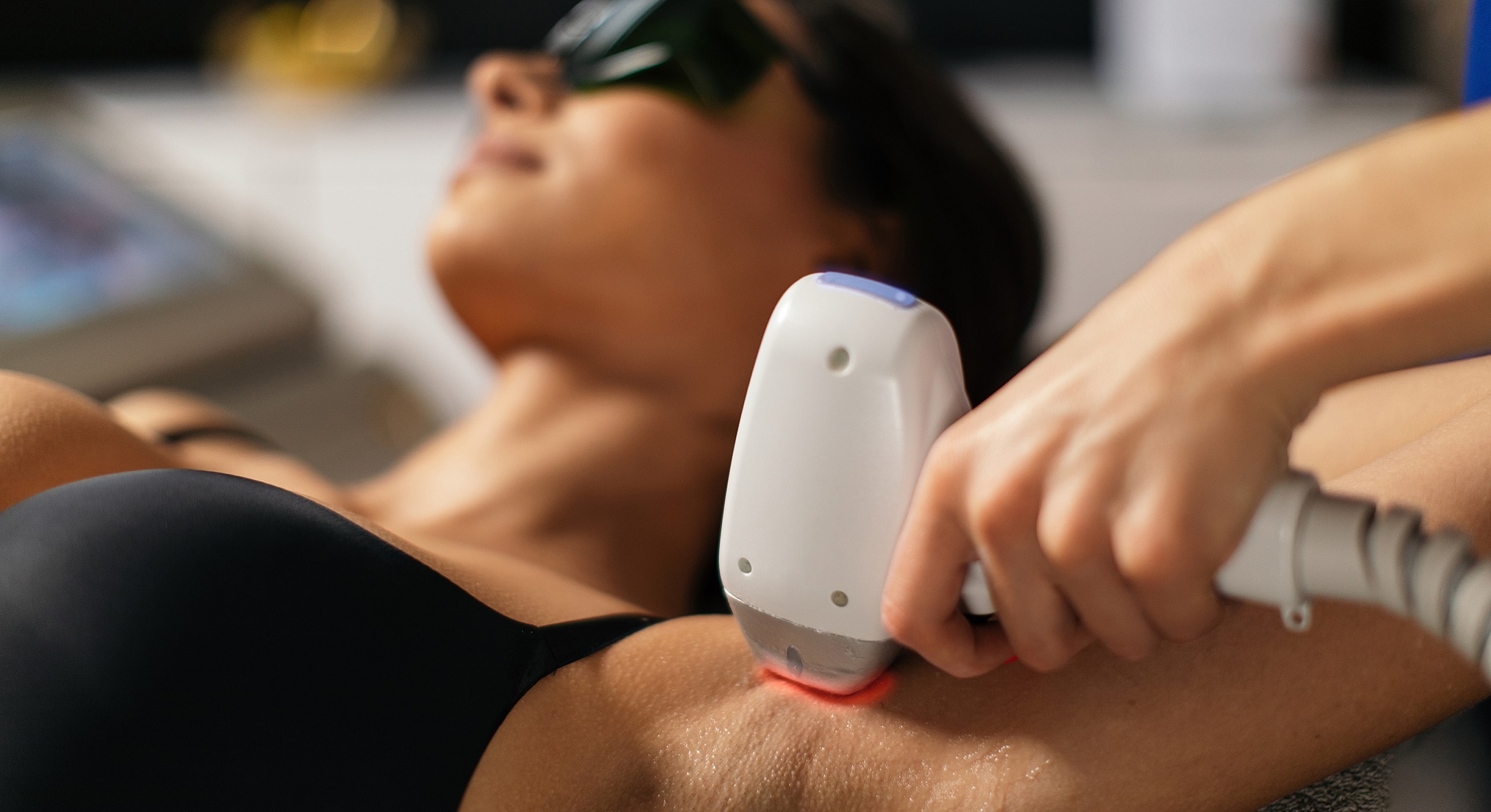 Laser hair removal procedure on underarm.
